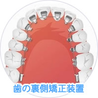 歯の裏側矯正装置