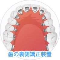 歯の裏側矯正装置