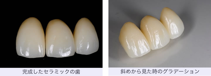 セラミックの歯