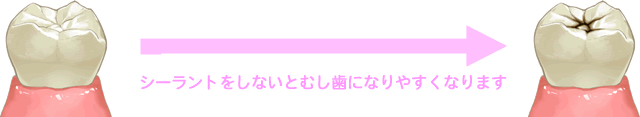 シーラントをしないと虫歯になります。