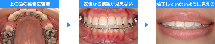 歯の裏側に矯正器具を装着した治療写真