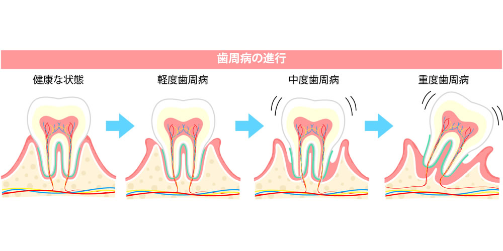 歯周病を進行・悪化させる原因