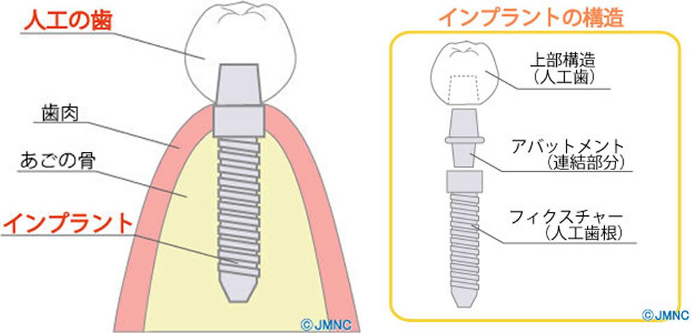 インプラントの構造