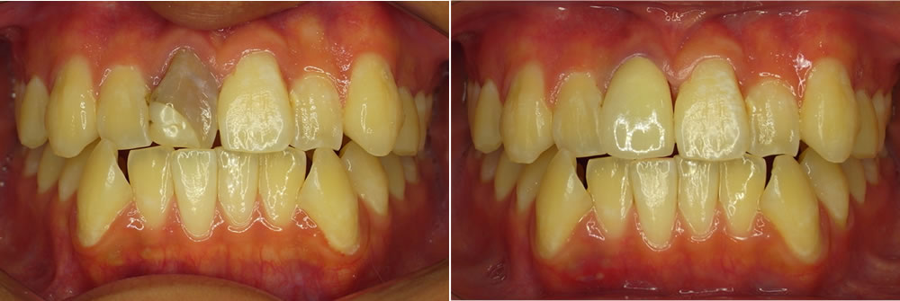神経がない歯セラミック変更