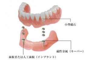 ③磁石の力で強力固定のマグネット義歯